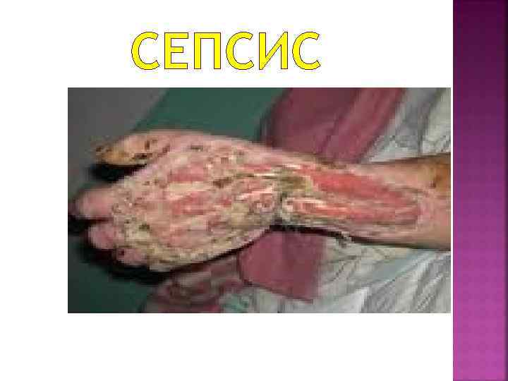СЕПСИС 