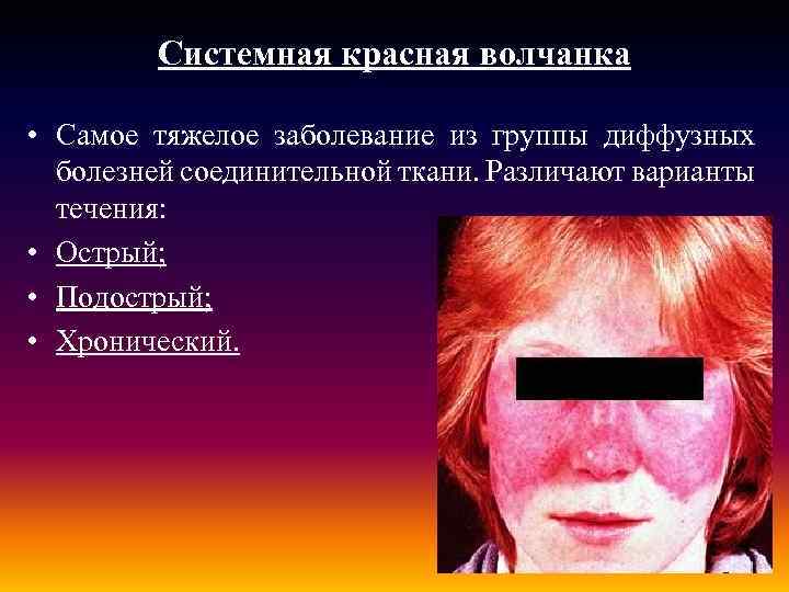 Системная красная волчанка • Самое тяжелое заболевание из группы диффузных болезней соединительной ткани. Различают
