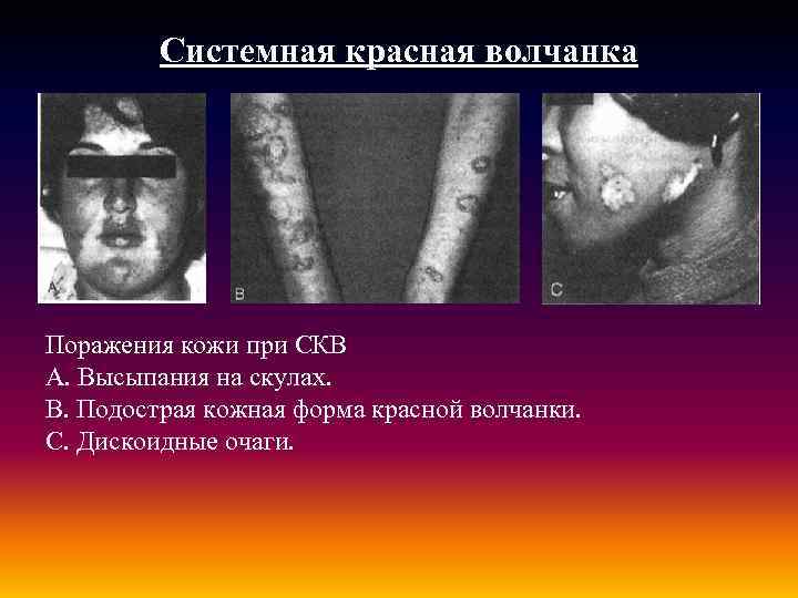Системная красная волчанка Поражения кожи при СКВ А. Высыпания на скулах. В. Подострая кожная