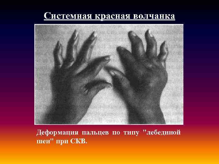 Системная красная волчанка Деформация пальцев по типу 