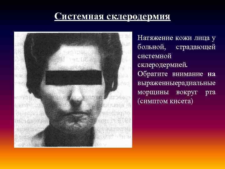 Системная склеродермия Натяжение кожи лица у больной, страдающей системной склеродермией. Обратите внимание на выраженные