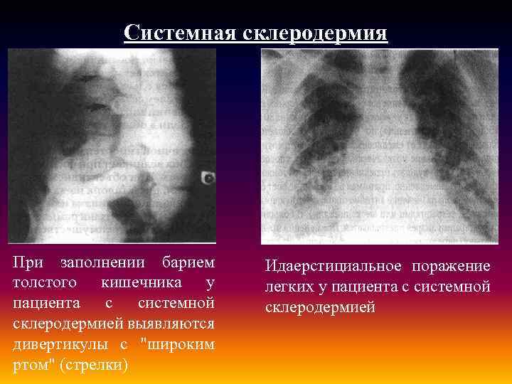 Системная склеродермия При заполнении барием толстого кишечника у пациента с системной склеродермией выявляются дивертикулы
