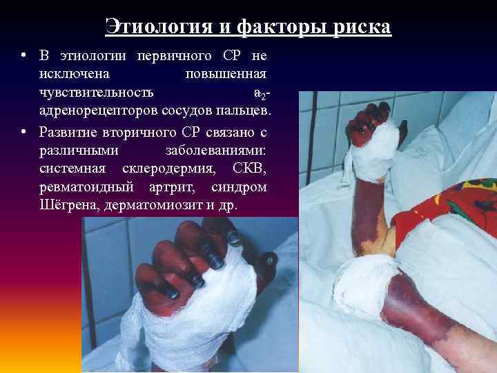 Этиология и факторы риска • В этиологии первичного СР не исключена повышенная чувствительность a