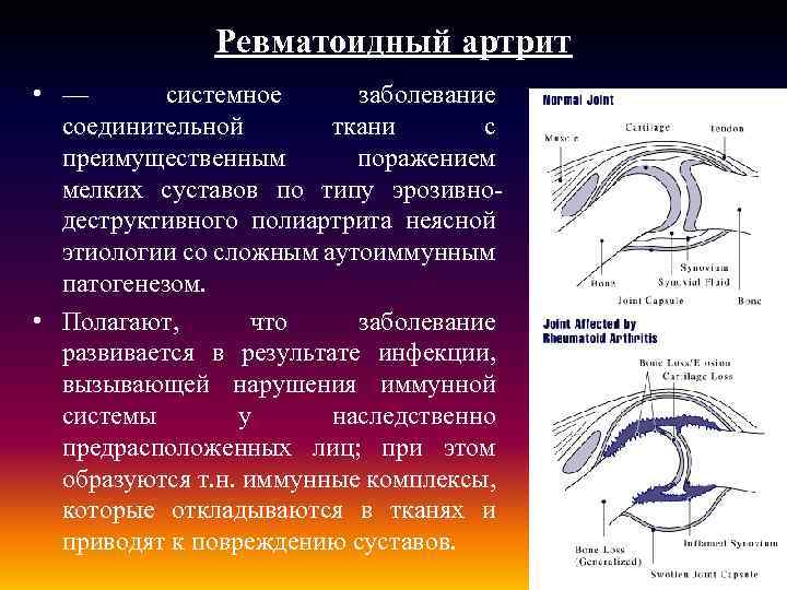 Ревматоидный артрит • — системное заболевание соединительной ткани с преимущественным поражением мелких суставов по