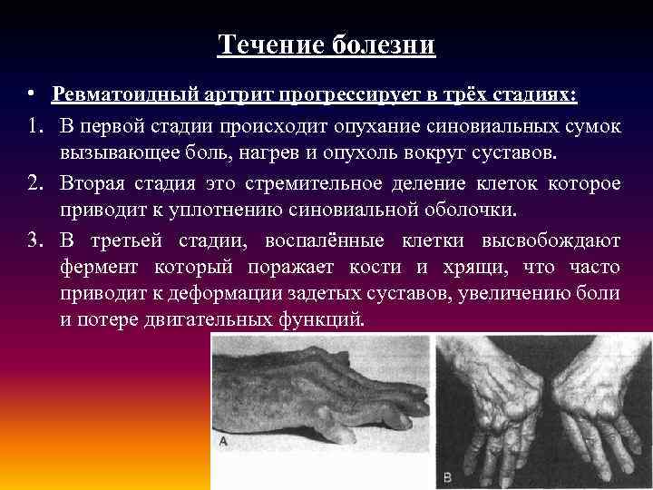 Течение болезни • Ревматоидный артрит прогрессирует в трёх стадиях: 1. В первой стадии происходит