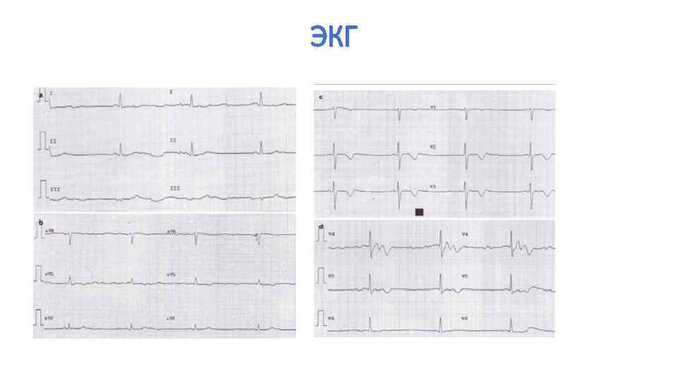 ЭКГ 