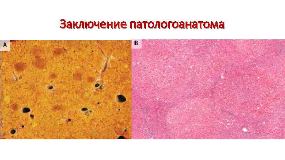 Заключение патологоанатома 