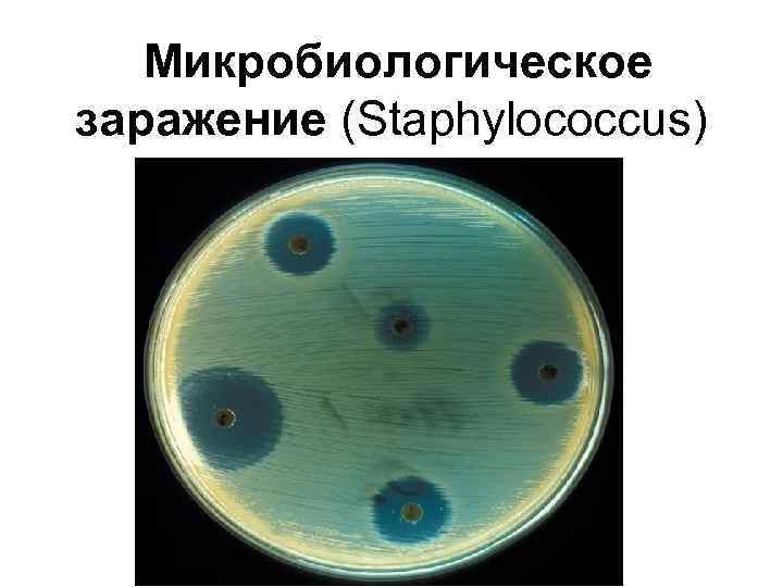 Микробиологическое заражение (Staphylococcus) 