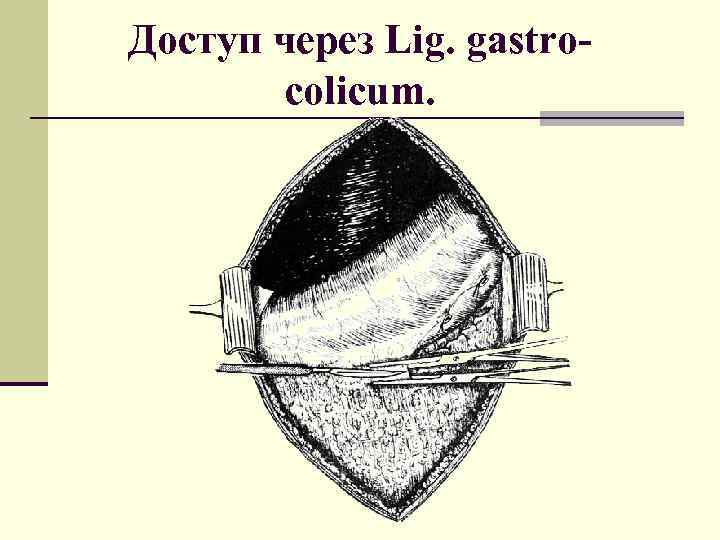 Доступ через Lig. gastrocolicum. 