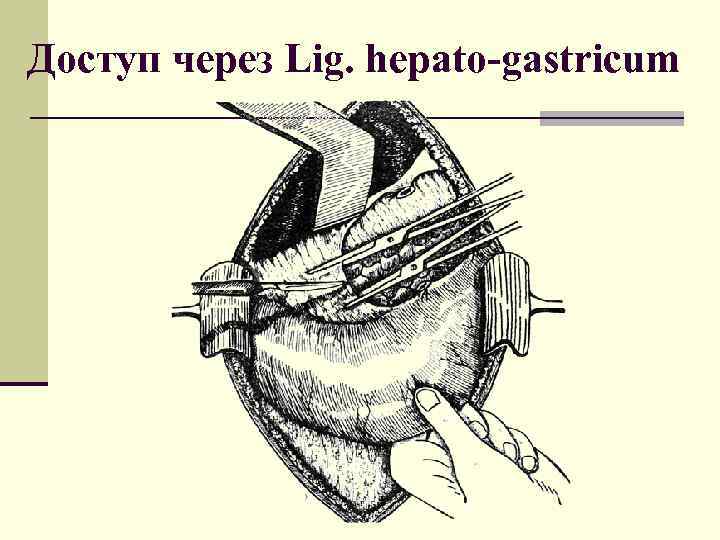 Доступ через Lig. hepato-gastricum 