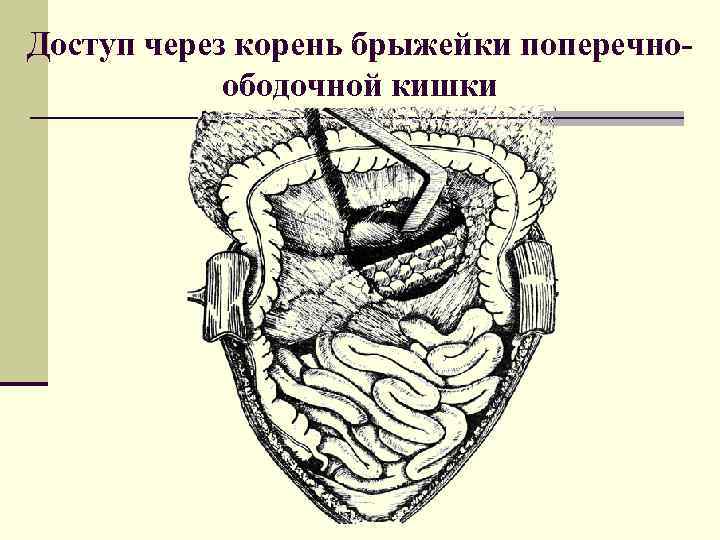 Доступ через корень брыжейки поперечноободочной кишки 