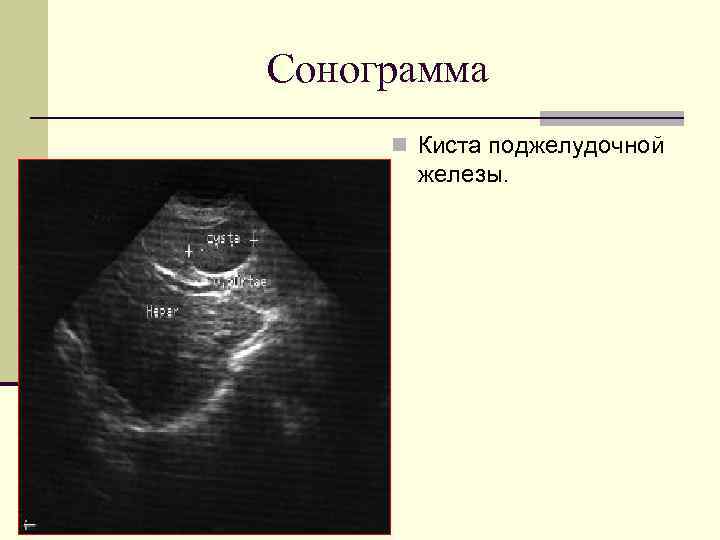 Сонограмма n Киста поджелудочной железы. 