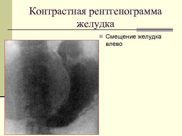 Контрастная рентгенограмма желудка n Смещение желудка влево 