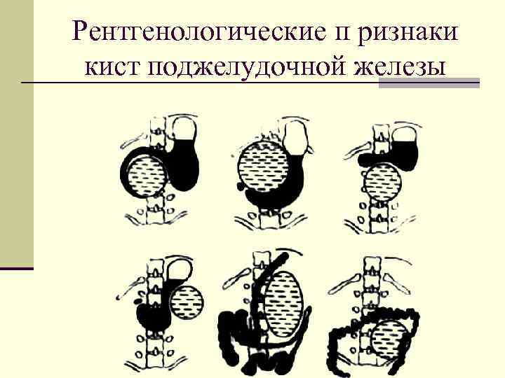 Рентгенологические п ризнаки кист поджелудочной железы 