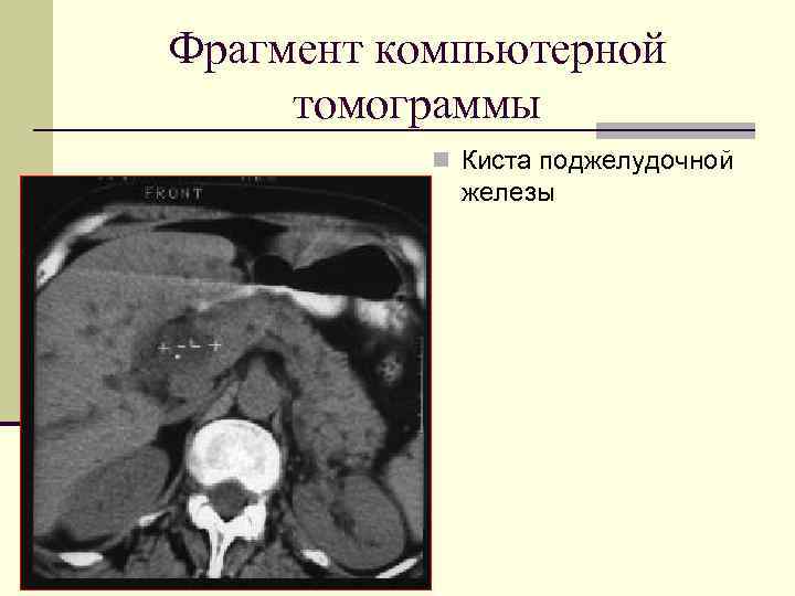Фрагмент компьютерной томограммы n Киста поджелудочной железы 