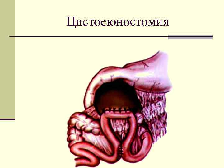 Цистоеюностомия 