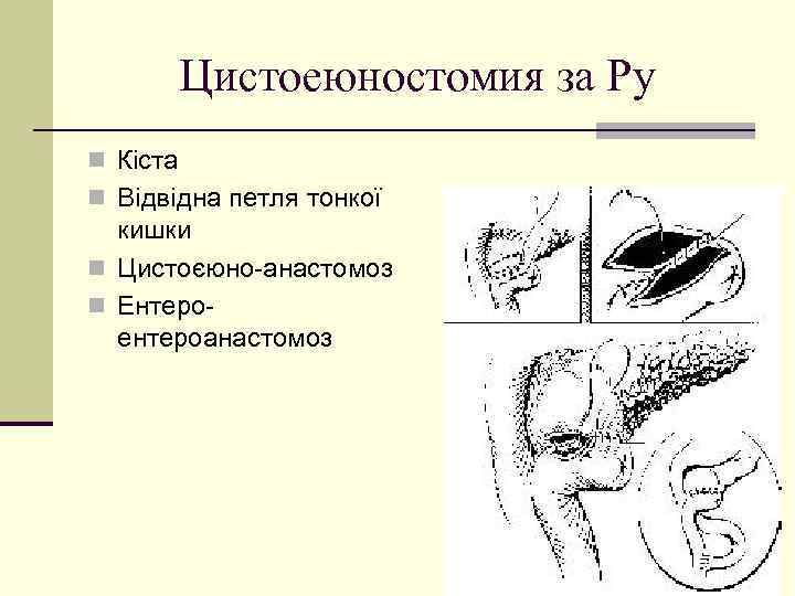 Цистоеюностомия за Ру n Кiста n Вiдвiдна петля тонкої кишки n Цистоєюно-анастомоз n Ентероентероанастомоз
