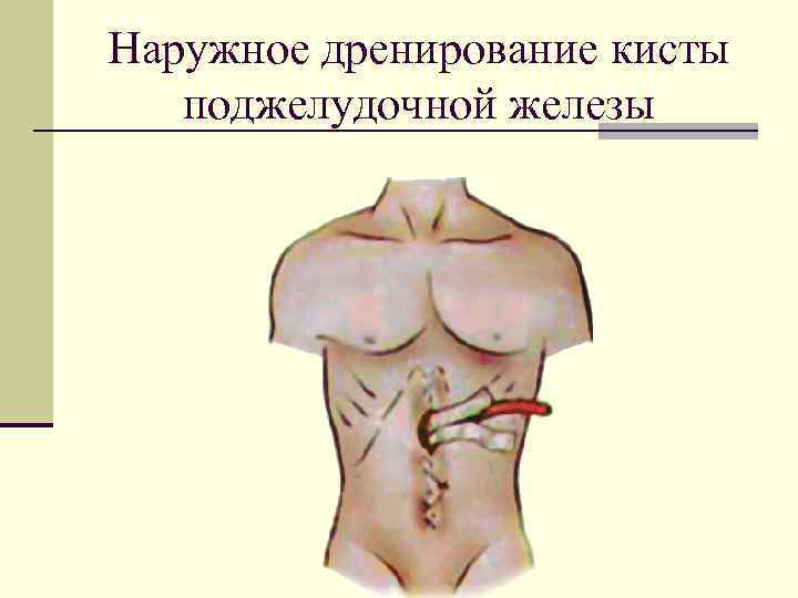Наружное дренирование кисты поджелудочной железы 