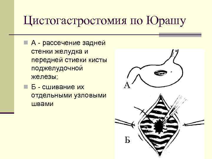 Цистогастростомия по Юрашу n А - рассечение задней стенки желудка и передней стиеки кисты