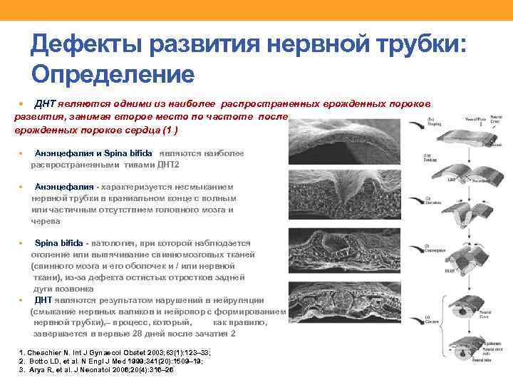 Дефекты развития нервной трубки: Определение ДНТ являются одними из наиболее распространенных врожденных пороков развития,