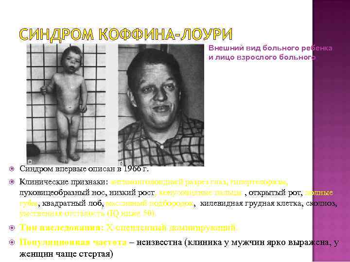 СИНДРОМ КОФФИНА-ЛОУРИ Внешний вид больного ребенка и лицо взрослого больного Синдром впервые описан в