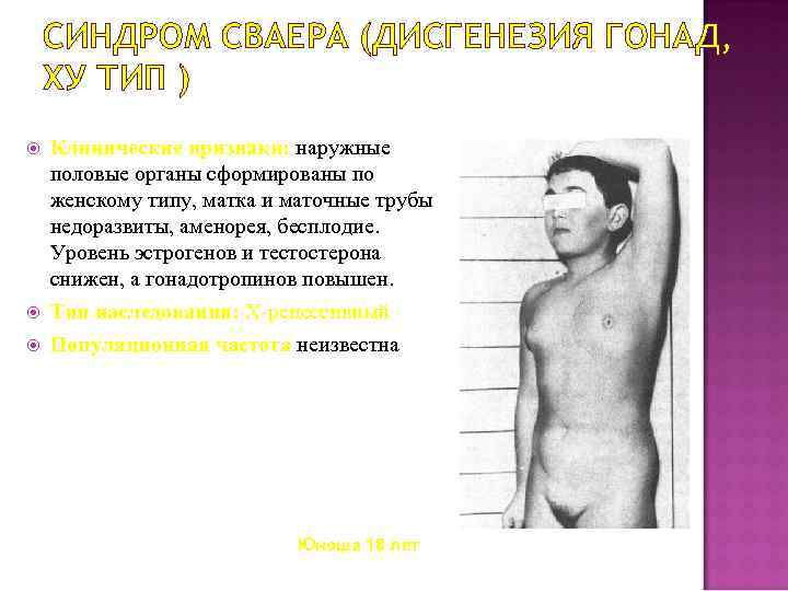 СИНДРОМ СВАЕРА (ДИСГЕНЕЗИЯ ГОНАД, ХУ ТИП ) Клинические признаки: наружные половые органы сформированы по