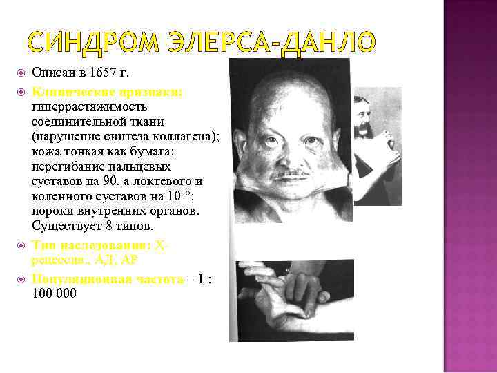 СИНДРОМ ЭЛЕРСА-ДАНЛО Описан в 1657 г. Клинические признаки: гиперрастяжимость соединительной ткани (нарушение синтеза коллагена);