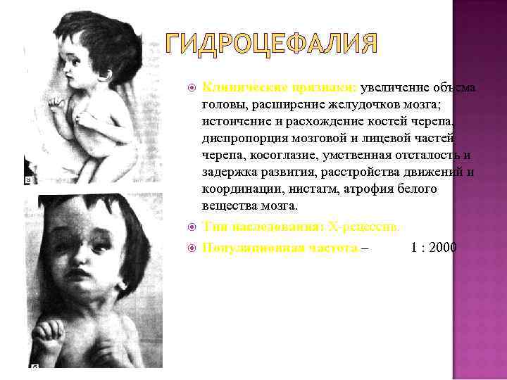 ГИДРОЦЕФАЛИЯ Клинические признаки: увеличение объема головы, расширение желудочков мозга; истончение и расхождение костей черепа,