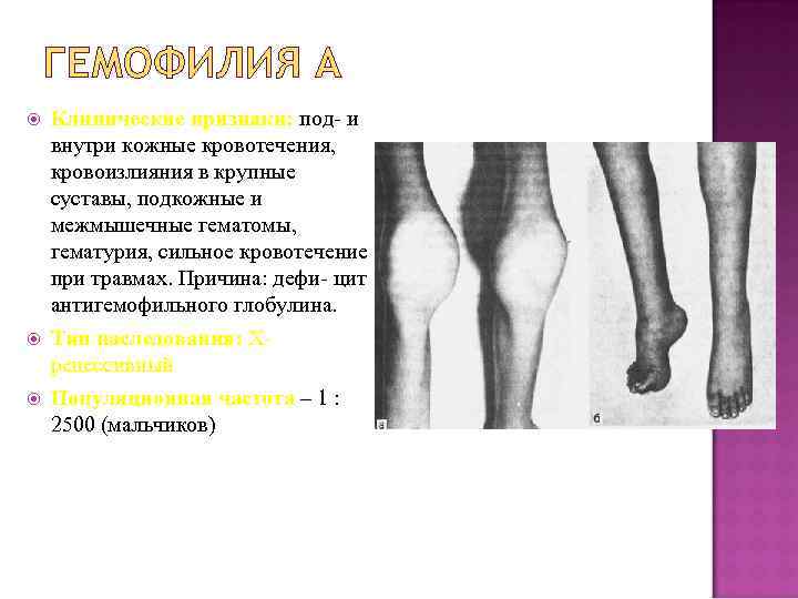 ГЕМОФИЛИЯ А Клинические признаки: под- и внутри кожные кровотечения, кровоизлияния в крупные суставы, подкожные