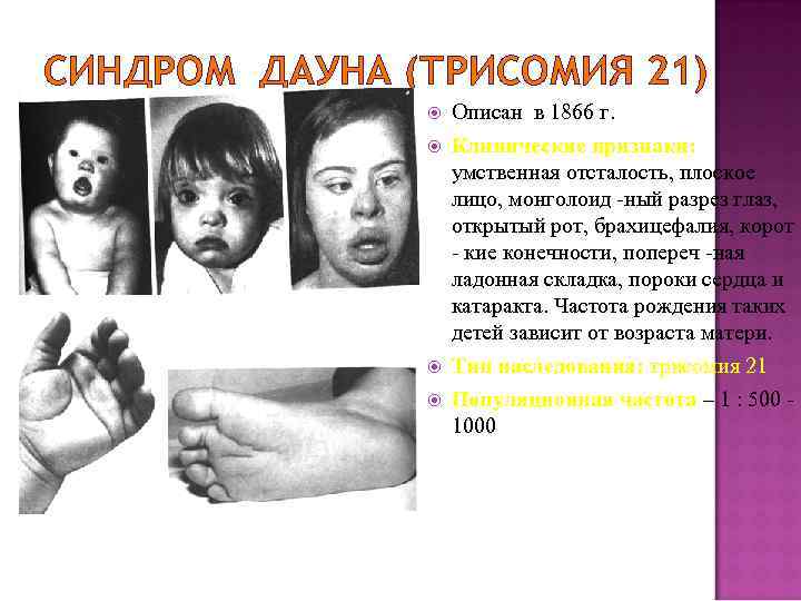 СИНДРОМ ДАУНА (ТРИСОМИЯ 21) Описан в 1866 г. Клинические признаки: умственная отсталость, плоское лицо,