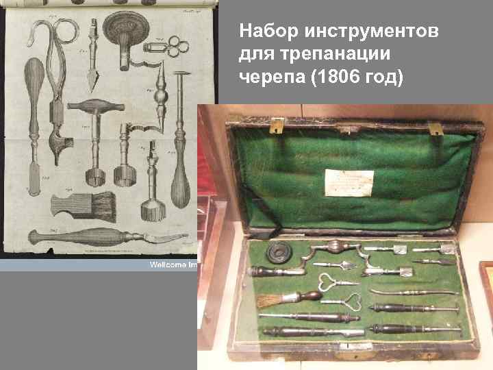 Набор инструментов для трепанации черепа (1806 год) 