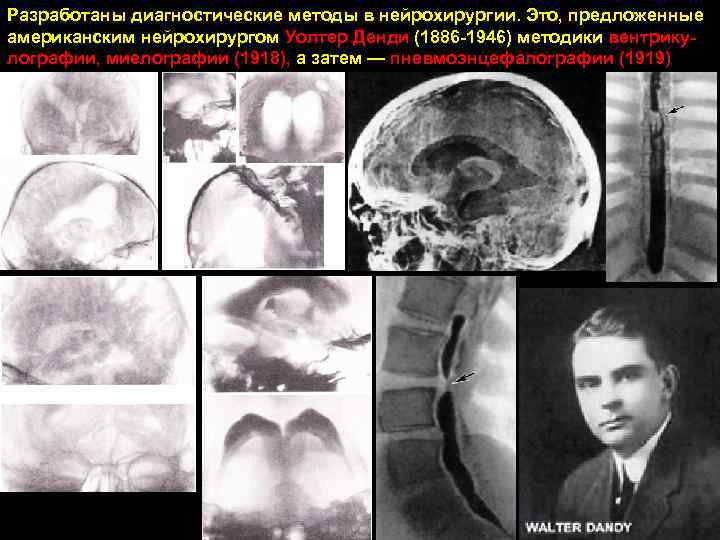 Разработаны диагностические методы в нейрохирургии. Это, предложенные американским нейрохирургом Уолтер Денди (1886 -1946) методики