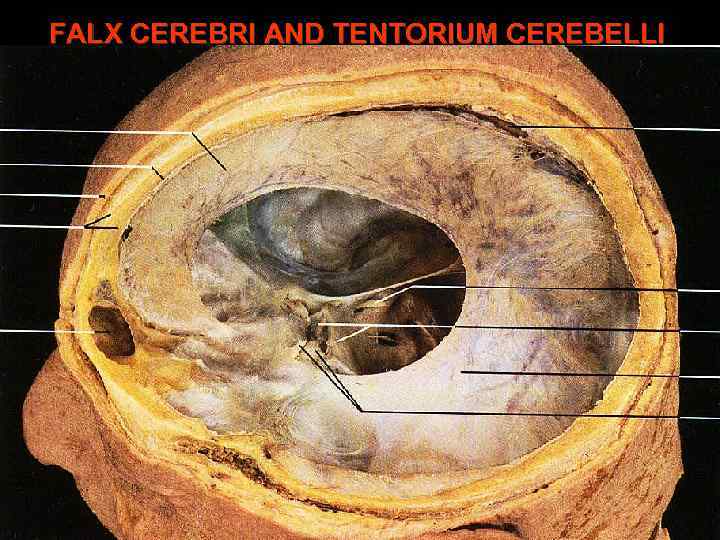 FALX CEREBRI AND TENTORIUM CEREBELLI 