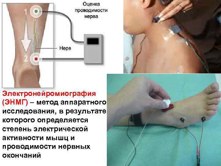 Электронейромиография (ЭНМГ) – метод аппаратного исследования, в результате которого определяется степень электрической активности мышц