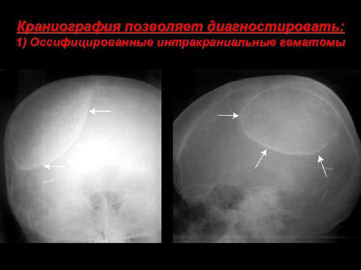 Краниография позволяет диагностировать: 1) Оссифицированные интракраниальные гематомы 
