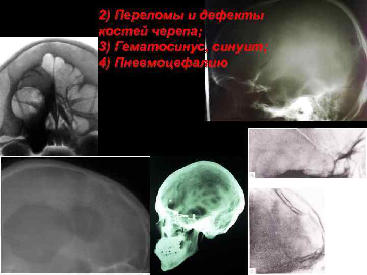 2) Переломы и дефекты костей черепа; 3) Гематосинус, синуит; 4) Пневмоцефалию 