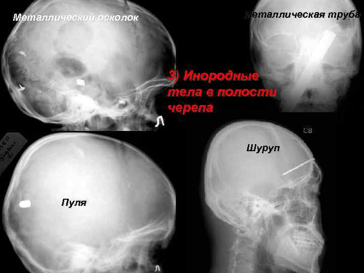 Металлический осколок Металлическая труба 3) Инородные тела в полости черепа Шуруп Пуля 