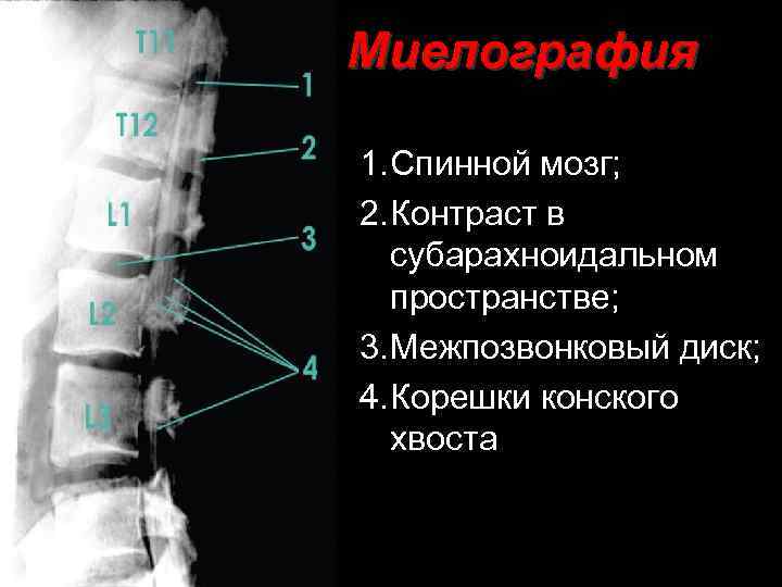 Конский хвост у человека в позвоночнике фото и что это такое