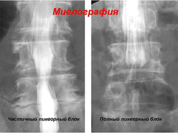 Миелография Частичный ликворный блок Полный ликворный блок 