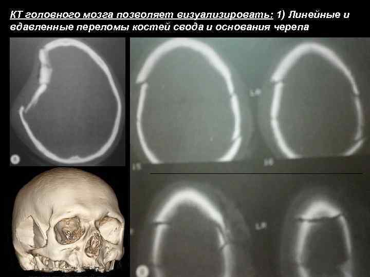 КТ головного мозга позволяет визуализировать: 1) Линейные и вдавленные переломы костей свода и основания