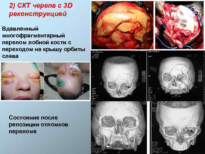 2) СКТ черепа с 3 D реконструкцией Вдавленный многофрагментарный перелом лобной кости с переходом