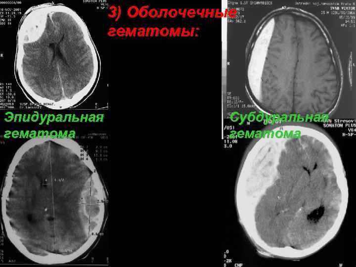 3) Оболочечные гематомы: Эпидуральная гематома Субдуральная гематома 