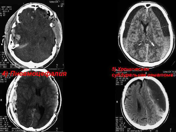 4) Пневмоцефалия 5) Хроническая субдуральная гематома 