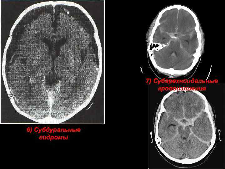 7) Субарахноидальные кровоизлияния 6) Субдуральные гидромы 