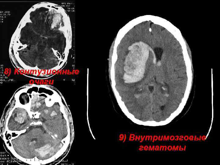 8) Контузионные очаги 9) Внутримозговые гематомы 