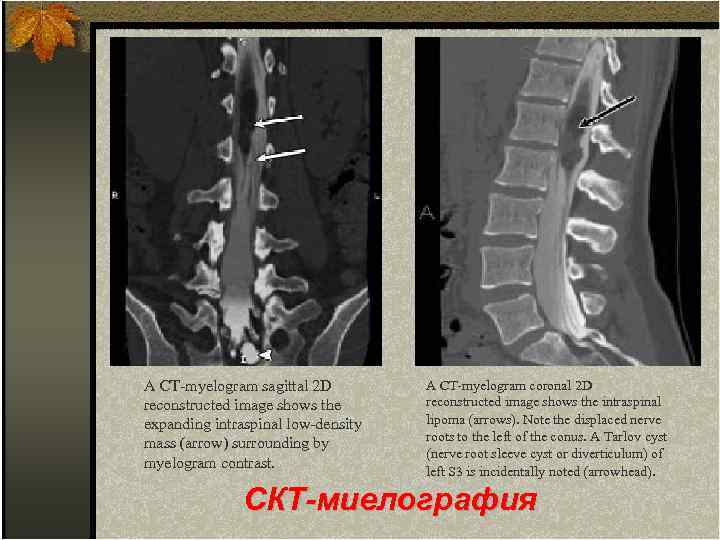 A CT-myelogram sagittal 2 D reconstructed image shows the expanding intraspinal low-density mass (arrow)