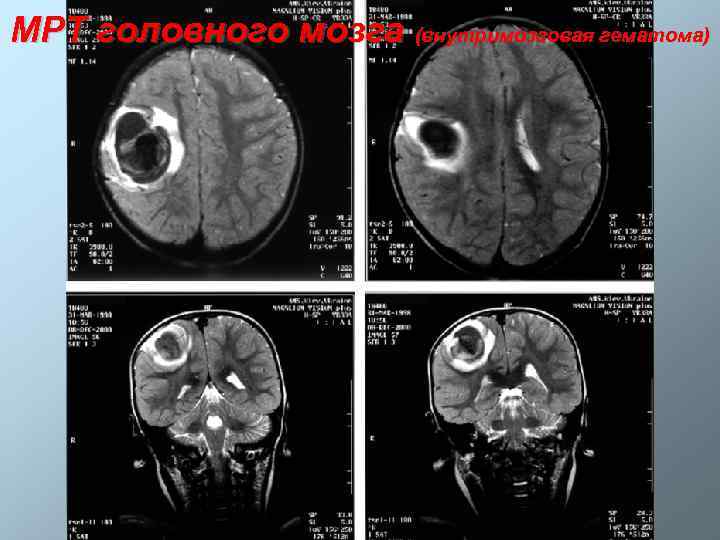 МРТ головного мозга (внутримозговая гематома) 