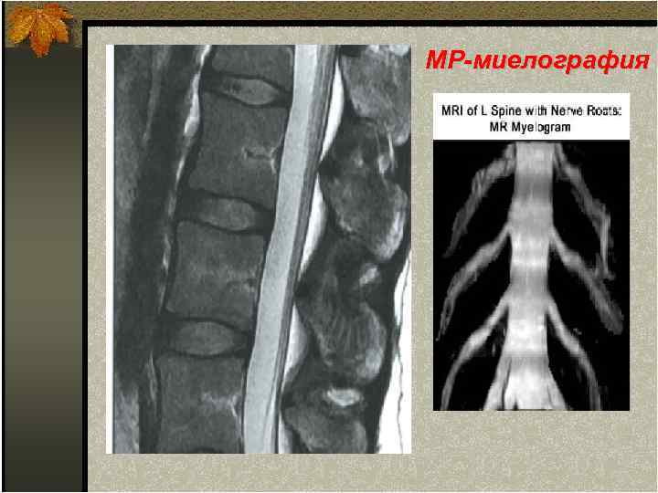 МР-миелография 