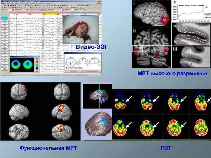 Видео-ЭЭГ МРТ высокого разрешения Функциональная МРТ ПЭТ 