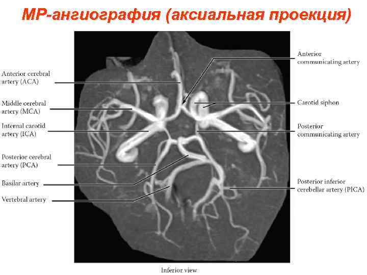 МР-ангиография (аксиальная проекция) 